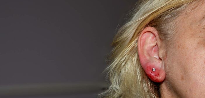 Allergie Piercing: Eine vielversprechende Methode zur Linderung von Allergiesymptomen (Foto: AdobeStock - 818930423 Claudia Evans)