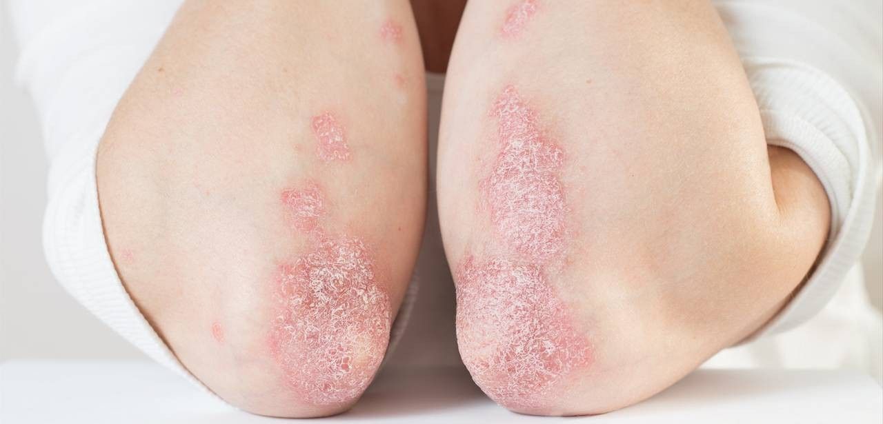 Schwangerschaft und Psoriasis: Herausforderung und Behandlungsoptionen für (Foto: AdobeStock 332799872  SNAB)